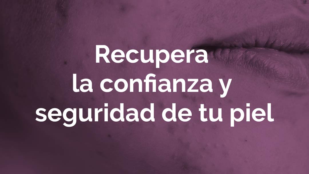 mujeres con Acné severo